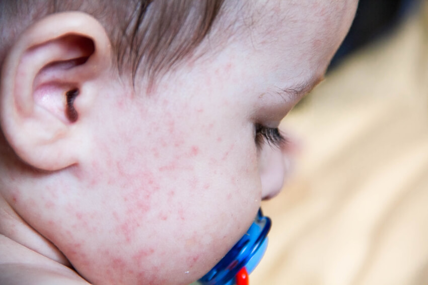 Alergia Pokarmowa U Dziecka • Dadapl 5683
